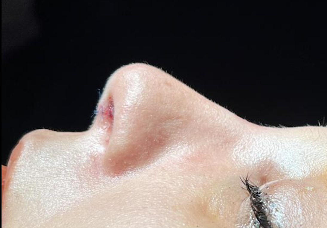 Rhinoplasty