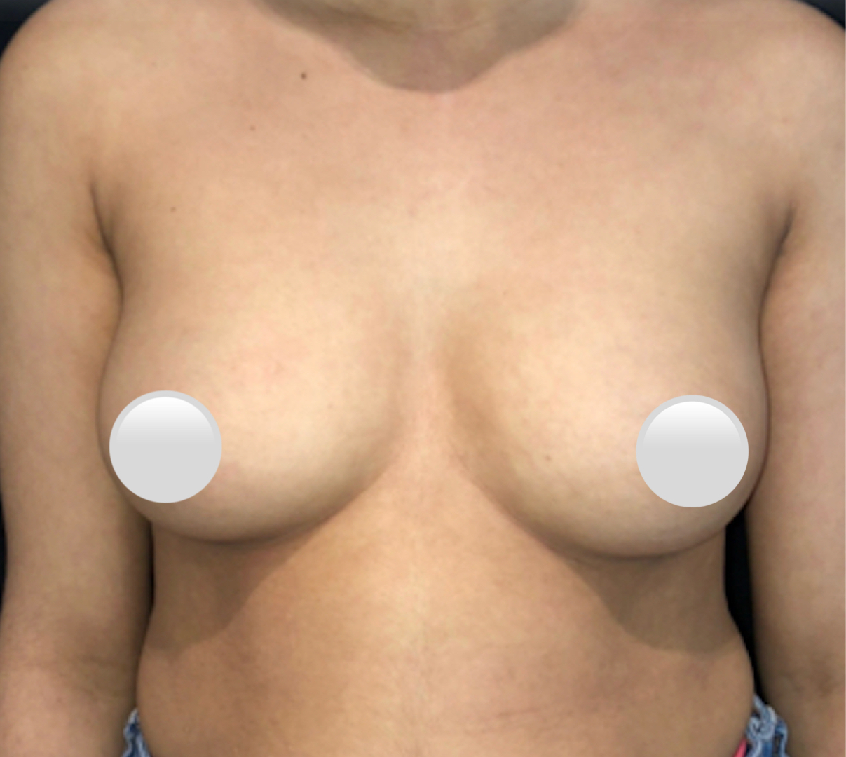 Breast Augmentation