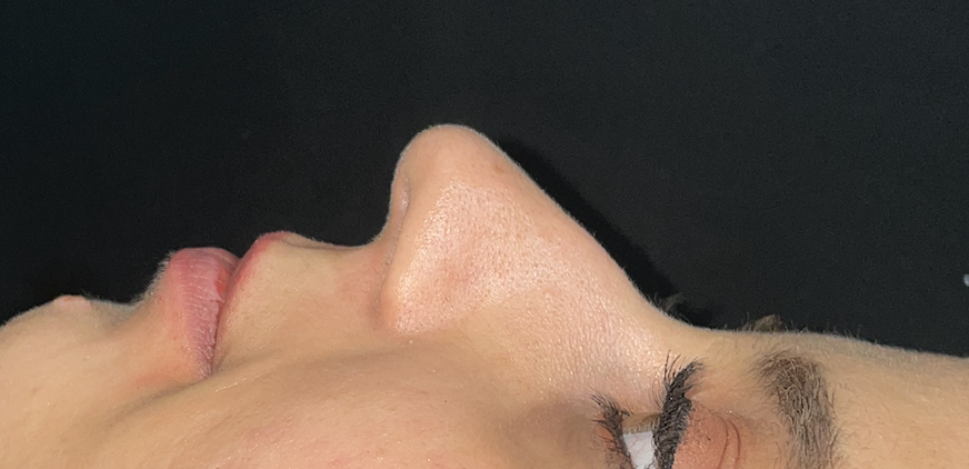Rhinoplasty
