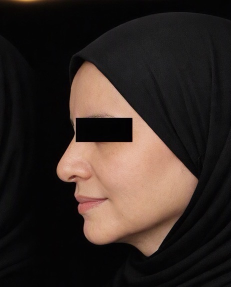 شد الوجه و الرقبه