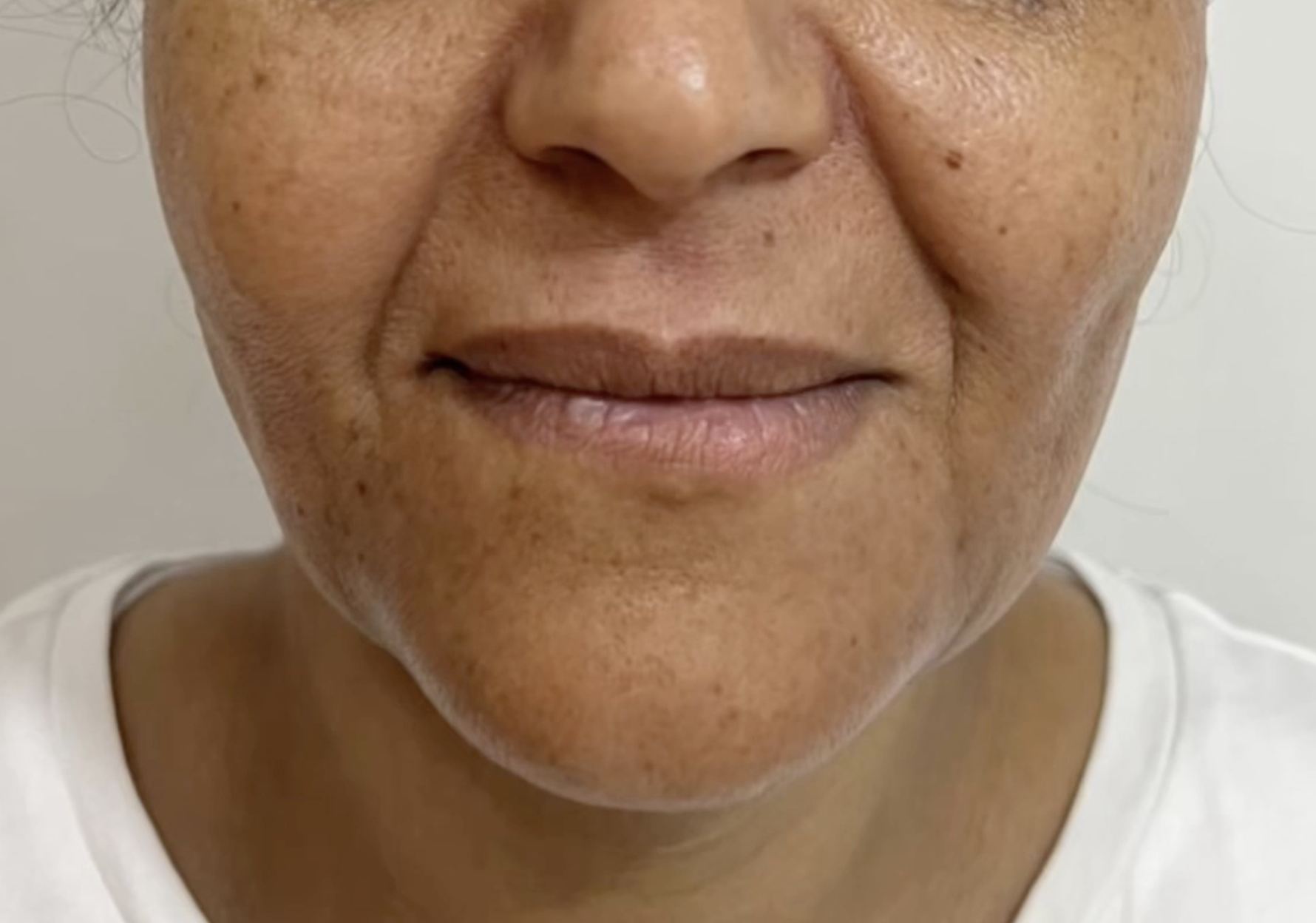 deep plane face and neck lift