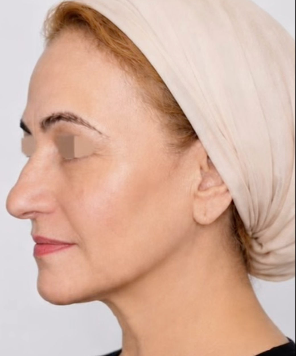 Deep plane face and neck lift
