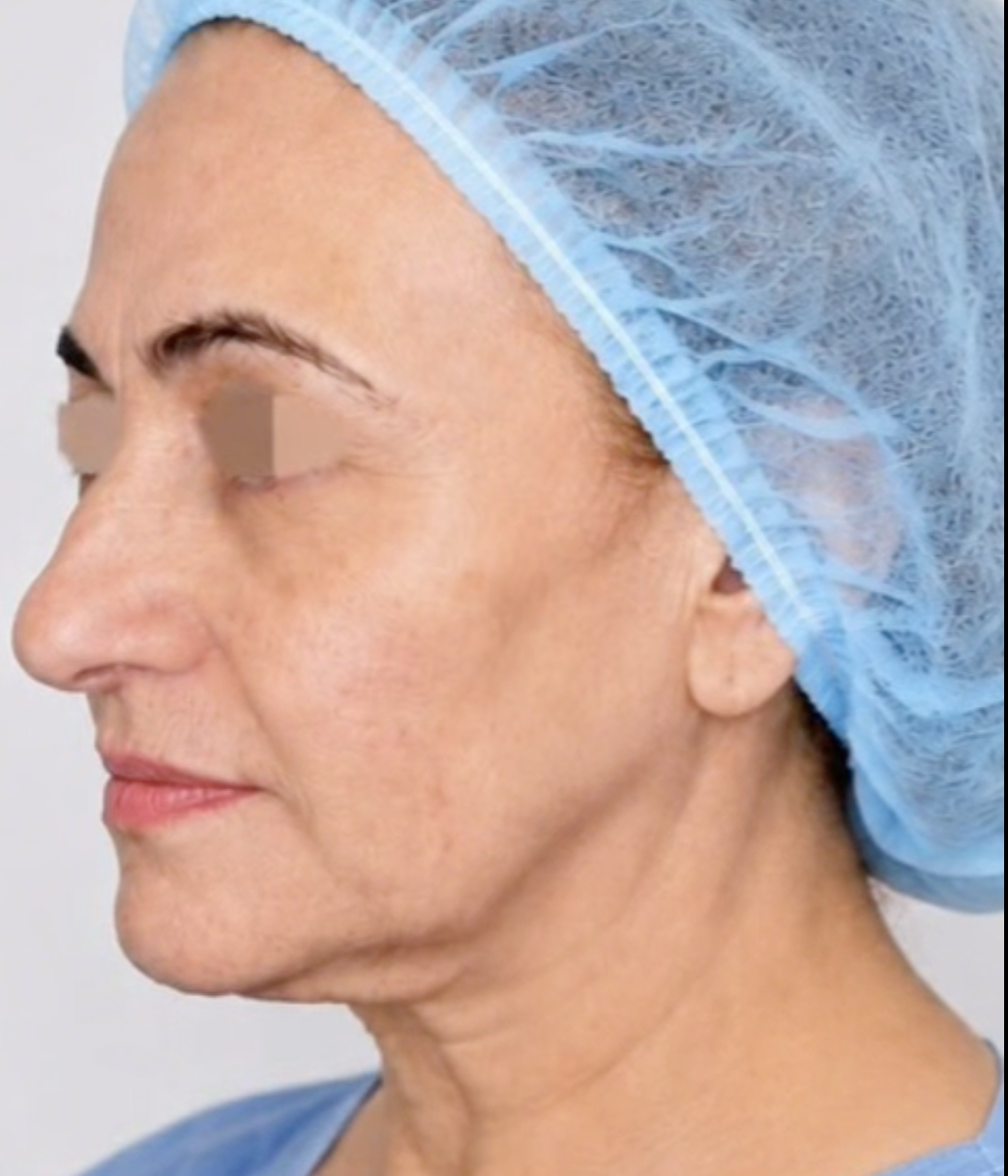 Deep plane face and neck lift
