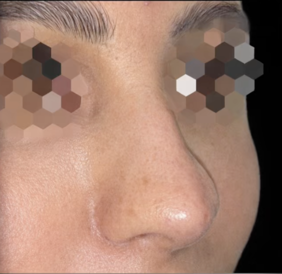 تجميل الأنف