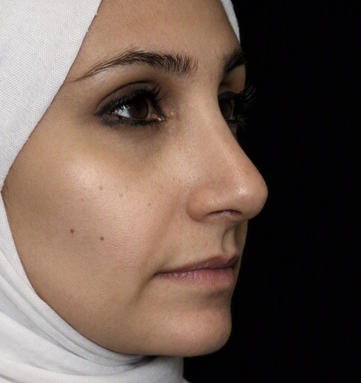 تجميل الأنف