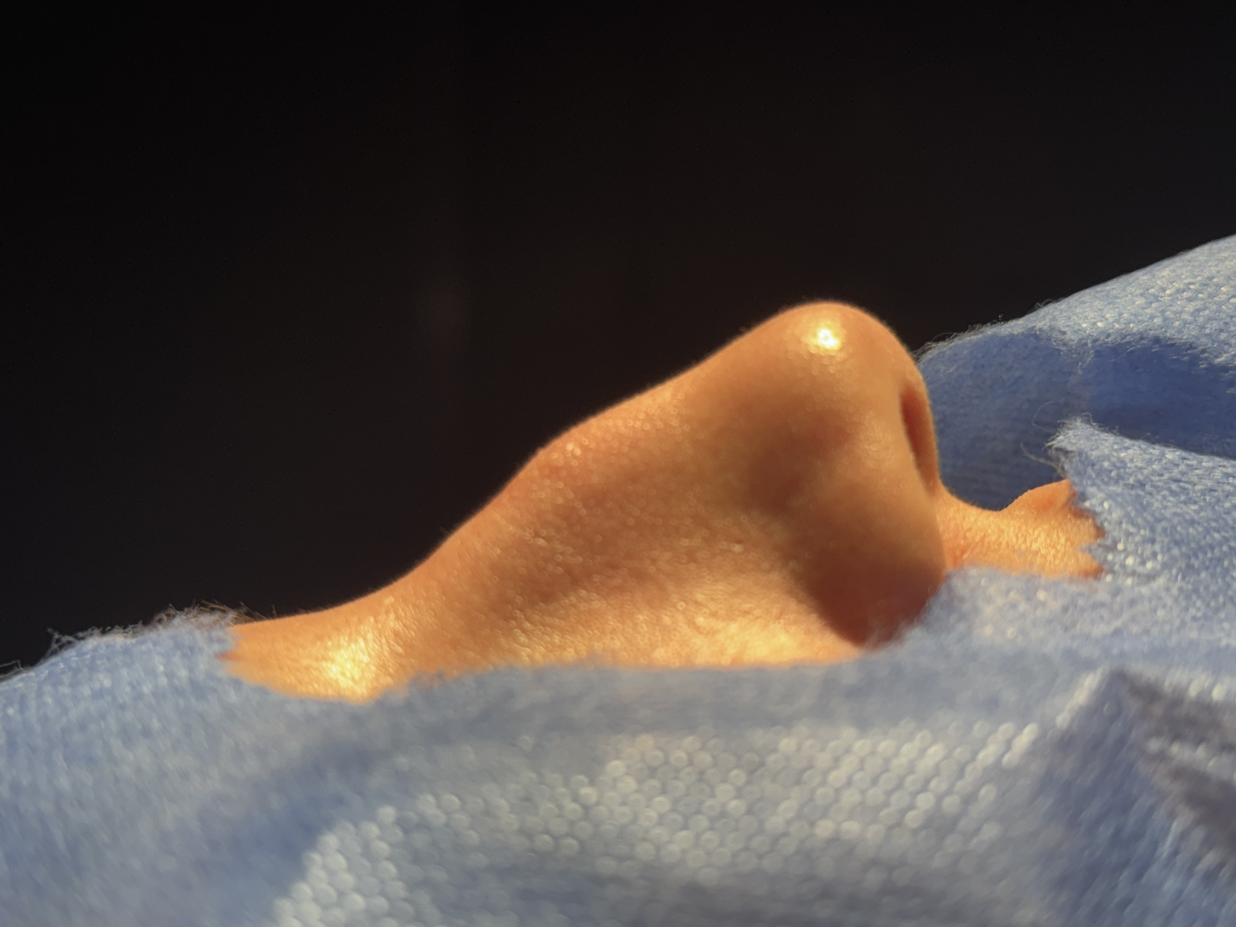 Rhinoplasty