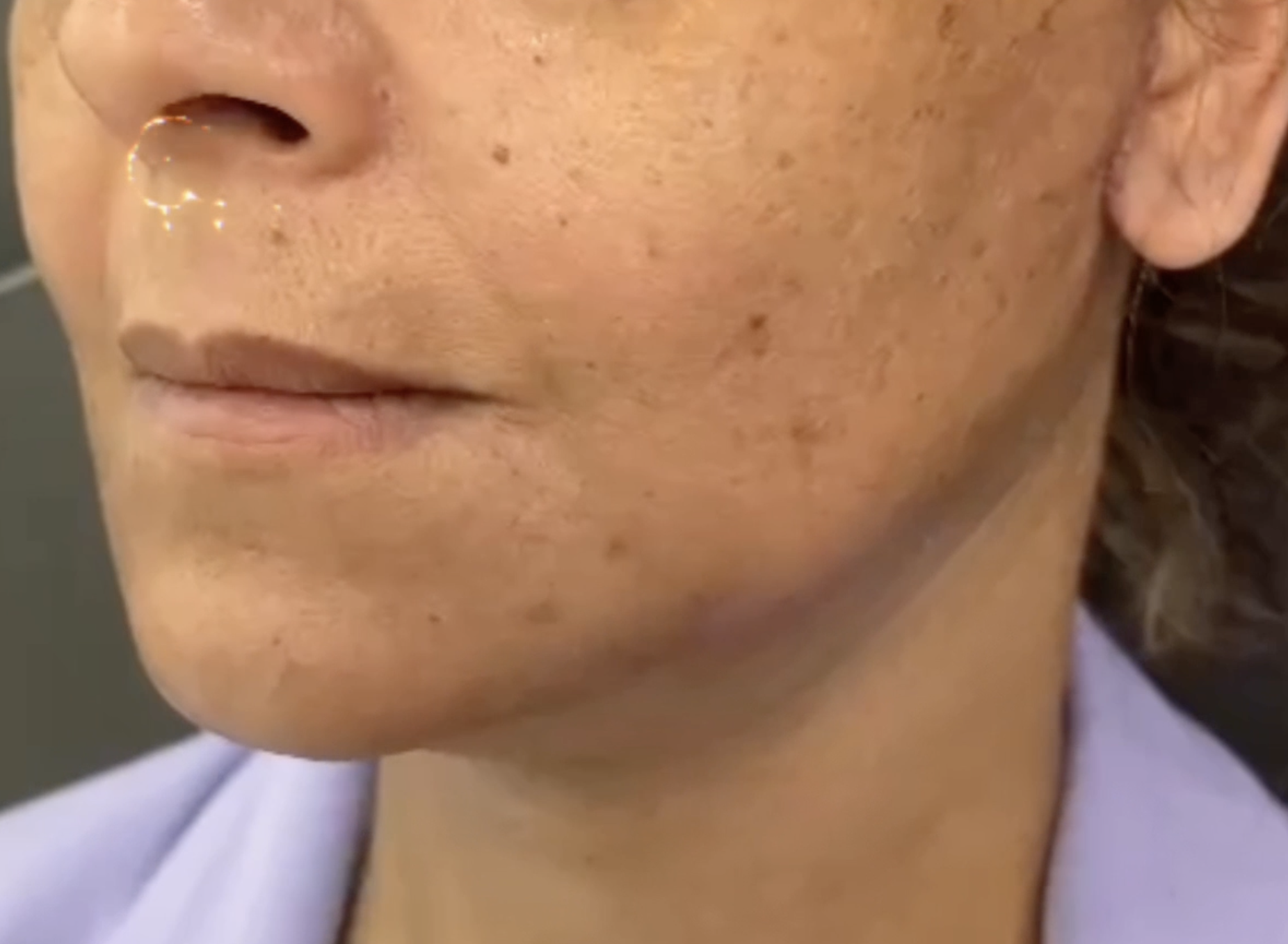 deep plane face and neck lift