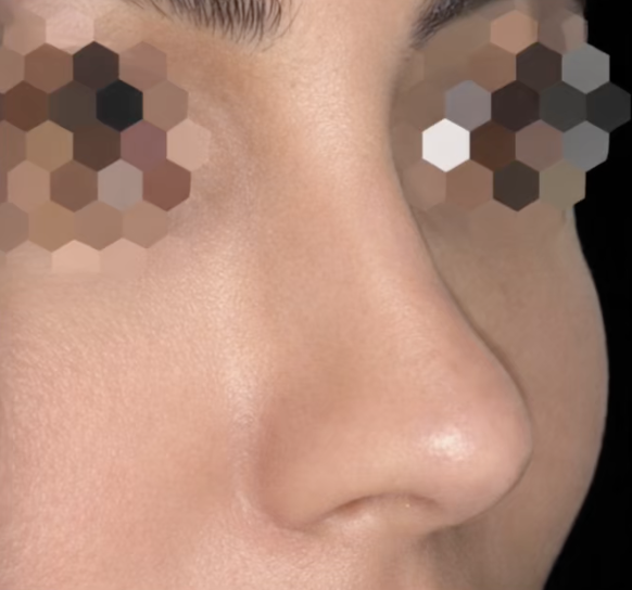 تجميل الأنف