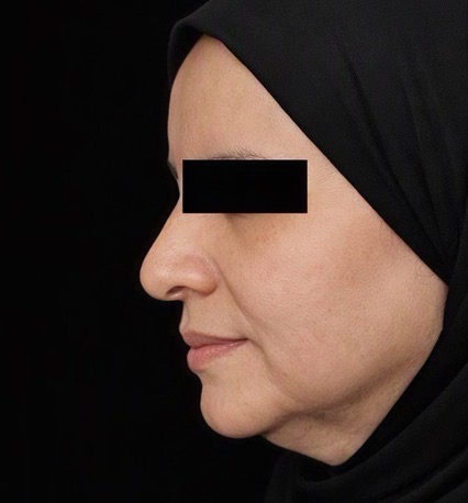شد الوجه و الرقبه
