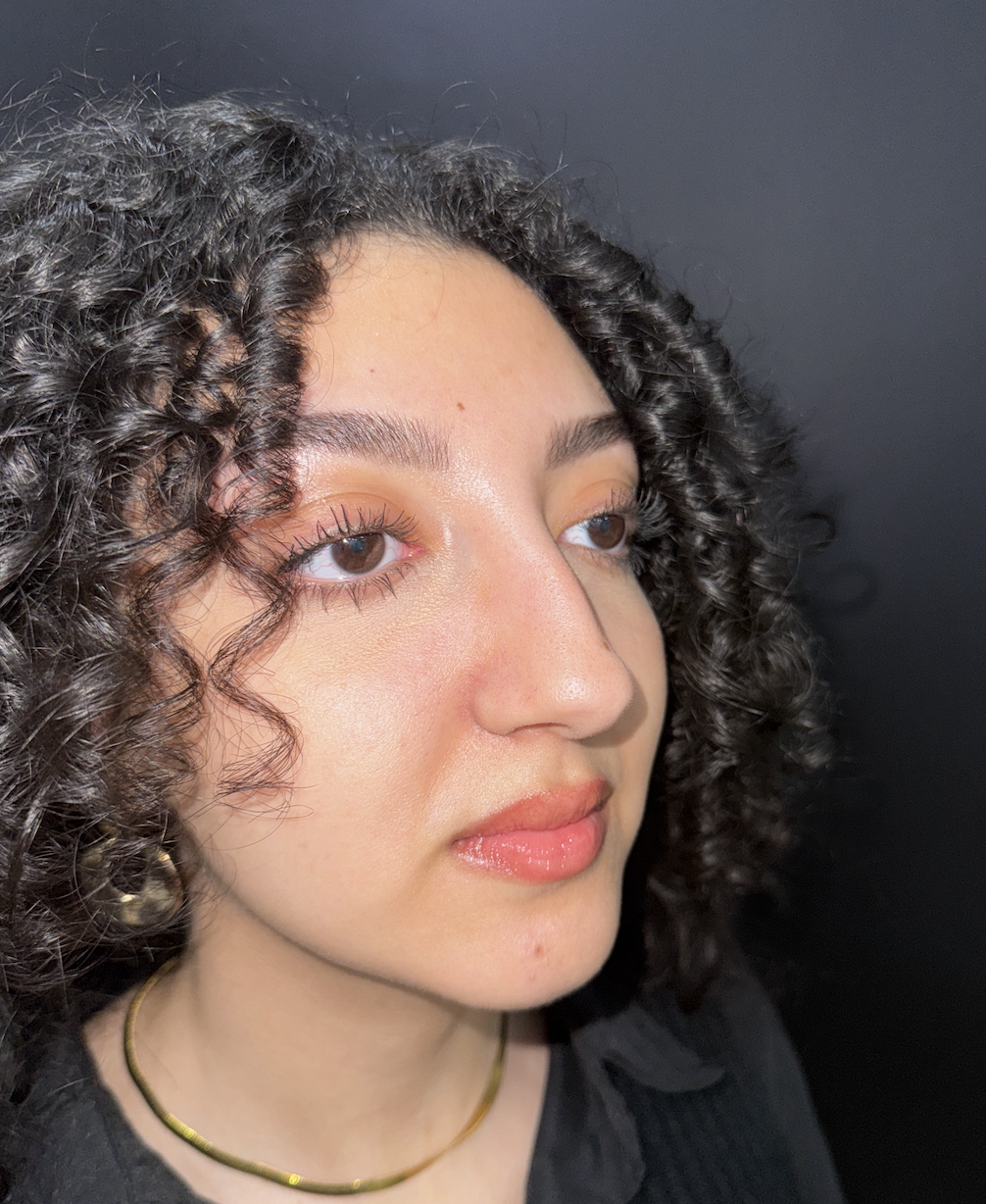 Rhinoplasty