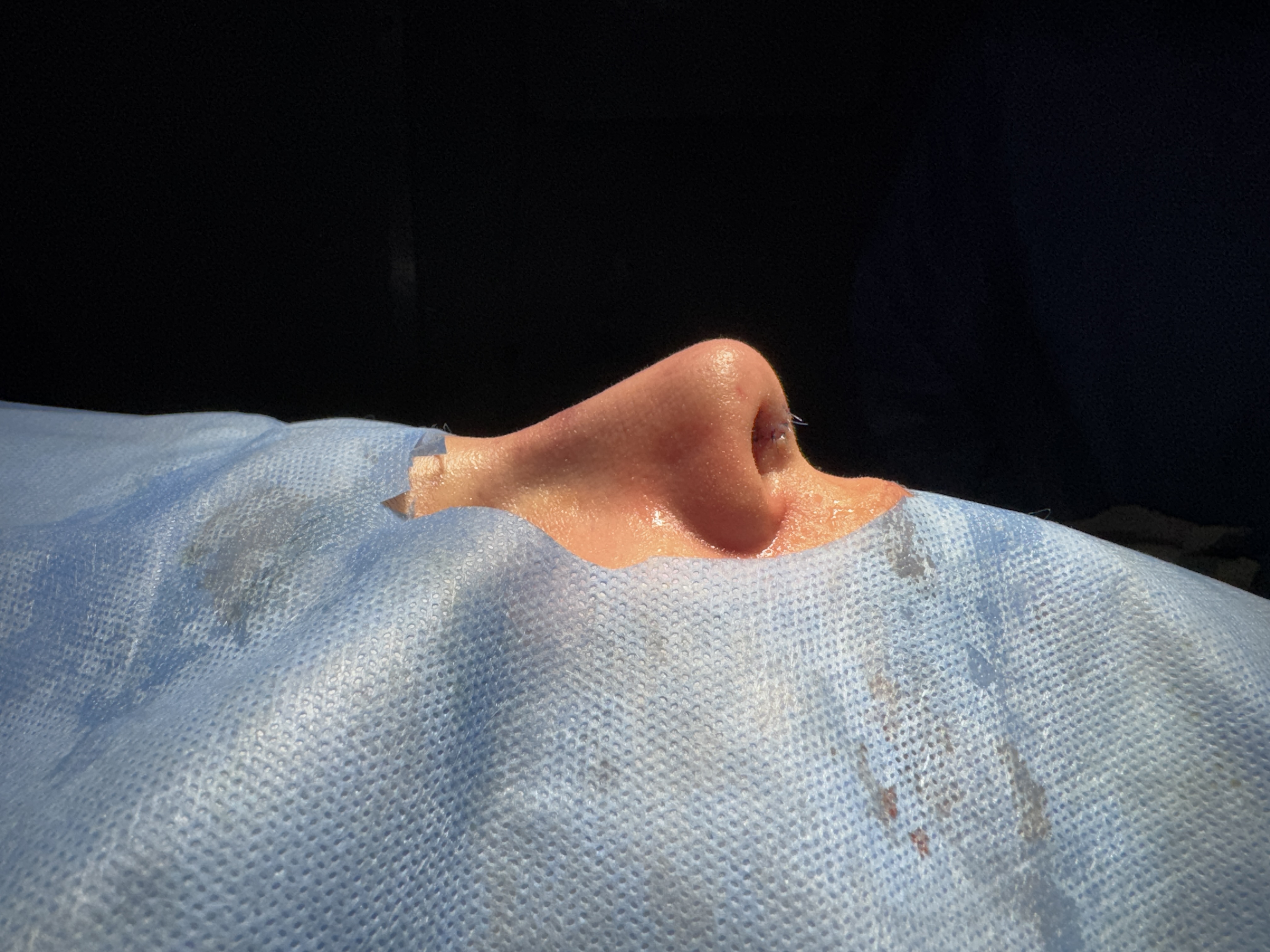 Rhinoplasty