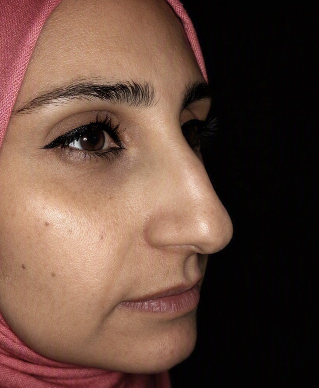 تجميل الأنف